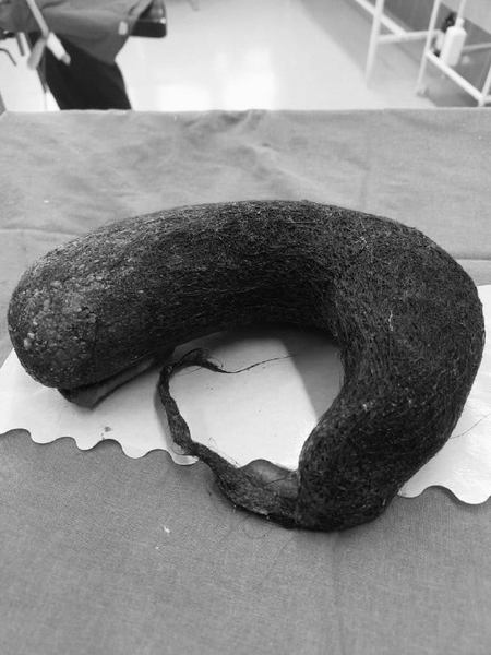 trichobezoar